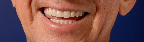 Dental Digital Photography in Dentistry Dr. Steven Goldstein Dentist Scottsdale, AZ