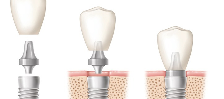 Dental Implane Diagram Dr. Steven Goldstein Dentist Scottsdale, AZ