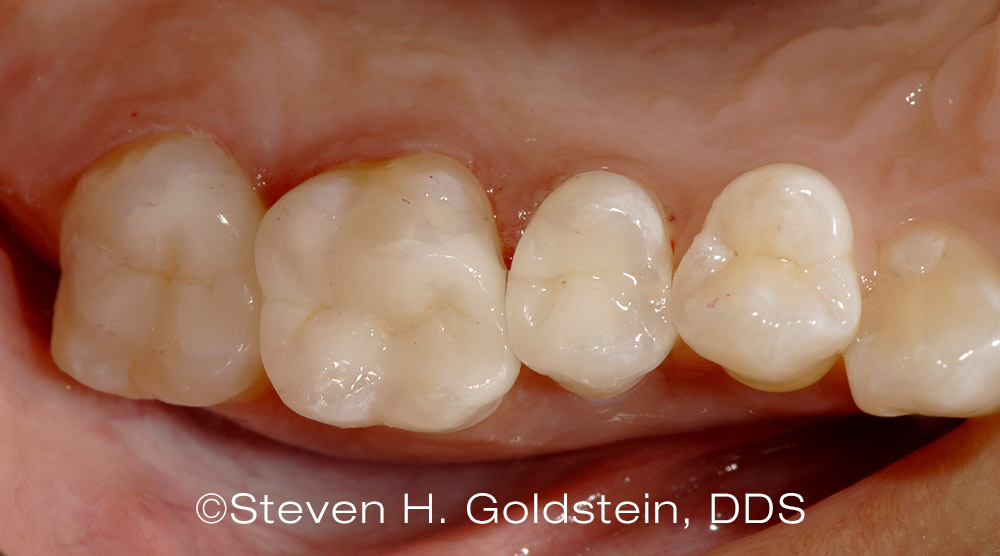 Bonded Porcelain Inlays Dental Restorations After Dr. Steven Goldstein Dentist Scottsdale, AZ