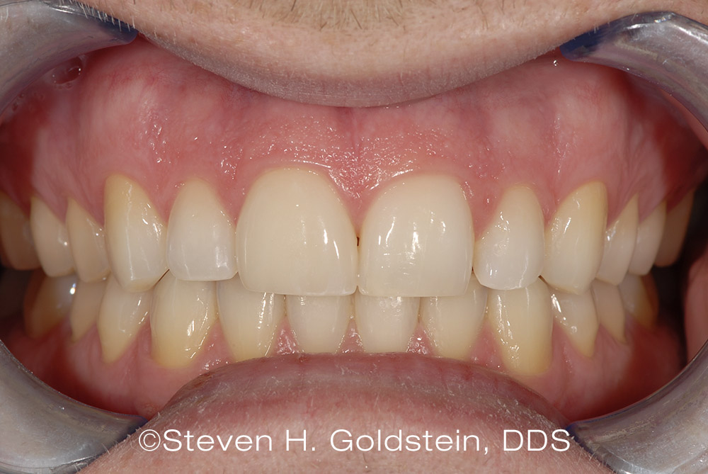 Single Porcelain Veneer Dental Restoration After Dr. Steven Goldstein Dentist Scottsdale, AZ