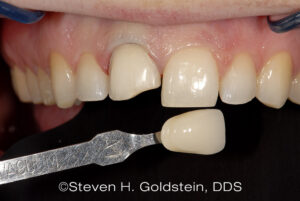 Single Porcelain Veneer Dental Restoration Before Shade Guide Dr. Steven Goldstein Dentist Scottsdale, AZ