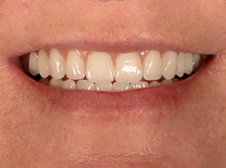 New Smile in a Day Dr. Steven Goldstein Dentist Scottsdale, AZ