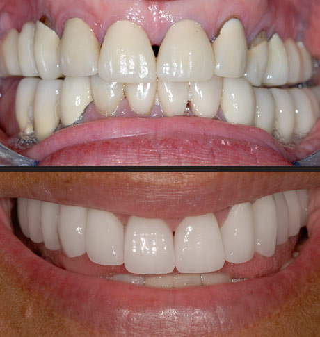 Restorative Dentistry Services Before & After Dr. Steven Goldstein Dentist Scottsdale, AZ